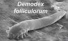 Demodex Mites Linked to Chronic Dry Eye Issues